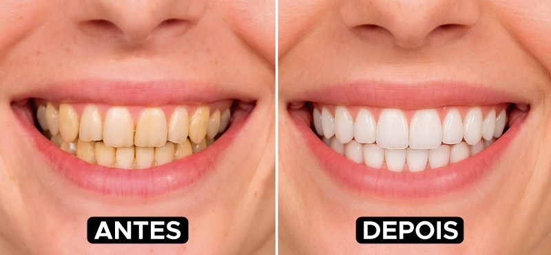 Antes e Depois Clareamento Dental - DentVidaMed - Curitiba