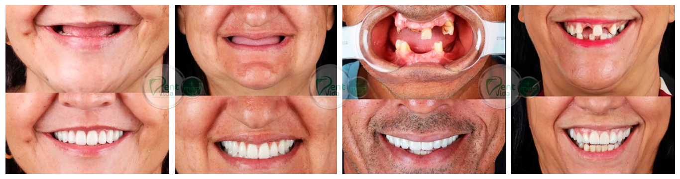 Prótese Dentária (fixa ou móvel) - DentVidaMed - Curitiba